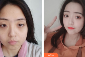 汕頭泛美泓涵醫(yī)療美容診所方曦環(huán)整形價格表附進口針注射瘦臉瘦臉案例展示