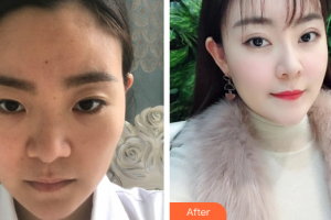 汕頭泛美泓涵醫(yī)療美容診所鄭少娜整形價格表附眼部手術案例展示