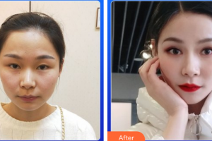 汕頭大學醫(yī)學院第一附屬醫(yī)院醫(yī)學美容中心鄭廷忠整形價格表附眼部整形案例展示