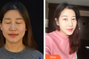 汕頭曙光整形美容醫(yī)院梁威杰整形價格表附熱瑪吉案例展示