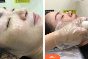 汕頭曙光整形美容醫(yī)院周麗整形價格表附玻尿酸精華導入案例展示