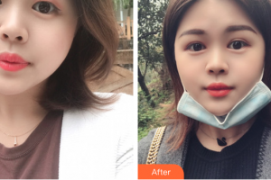 汕頭愛麗諾整形美容醫(yī)院蘇國藝整形價格表附雙眼皮案例展示