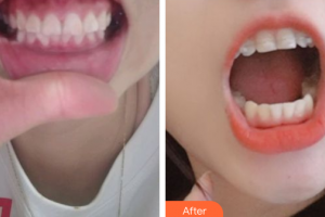 汕頭曙光整形美容醫(yī)院麻偉達整形價格表附國產直絲弓矯正案例展示