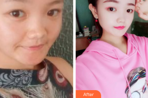 汕頭大學醫(yī)學院第一附屬醫(yī)院醫(yī)學美容中心李宇整形價格表附果酸煥膚案例展示