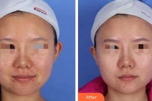 汕頭大學醫(yī)學院第一附屬醫(yī)院醫(yī)學美容中心李宏生整形價格表附皮膚管理案例展示