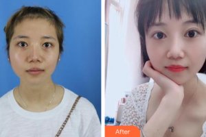 汕頭大學(xué)醫(yī)學(xué)院第一附屬醫(yī)院醫(yī)學(xué)美容中心蔡湘娜整形價(jià)格表附激光祛斑案例展示