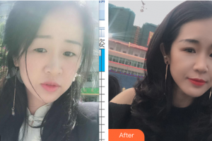 汕頭華美醫(yī)療美容醫(yī)院朱洙玉整形價(jià)格表附切開(kāi)雙眼皮案例展示