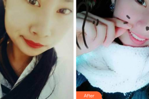 汕頭華美醫(yī)療美容醫(yī)院楊斌整形價(jià)格表附超聲波洗牙案例展示