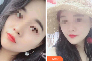 汕頭大學(xué)醫(yī)學(xué)院第二附屬醫(yī)院燒傷整形科楊旅軍整形價(jià)格表附超微小氣泡案例展示