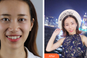 汕頭邱寧口腔診所許瑞芬整形價(jià)格表附全隱形牙齒矯正案例展示