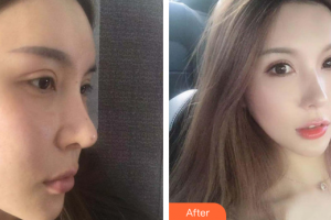 佛山曙光金子醫(yī)學(xué)美容醫(yī)院甘國(guó)端整形價(jià)格表附光子嫩膚案例展示