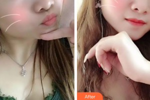 佛山亞韓整形美容門(mén)診部時(shí)安平整形價(jià)格表附紅藍(lán)光祛痘案例展示