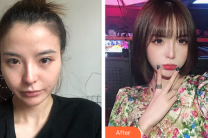 佛山曙光金子醫(yī)學(xué)美容醫(yī)院劉洲尉整形價(jià)格表附面部吸脂案例展示