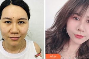 佛山曙光金子醫(yī)學(xué)美容醫(yī)院邱會(huì)銀整形價(jià)格表附超激光美膚案例展示