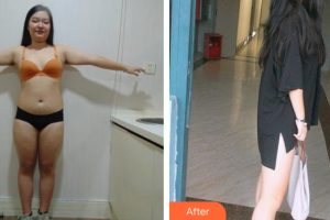 佛山東方女子醫(yī)院整形美容中心姜政輝整形價(jià)格表附水動(dòng)力吸脂案例展示