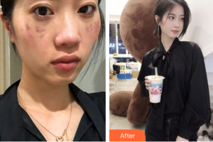 佛山市第一人民醫(yī)院醫(yī)學(xué)美容科劉必來(lái)整形價(jià)格表附祛斑案例展示