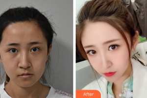 佛山市第一人民醫(yī)院醫(yī)學(xué)美容科楊榮梅整形價(jià)格表附二氧化碳點(diǎn)痣案例展示