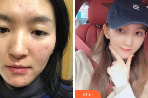 佛山市第一人民醫(yī)院醫(yī)學(xué)美容科黎詠璇整形價(jià)格表附微針美膚案例展示