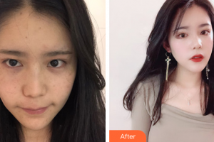 佛山市第二人民醫(yī)院醫(yī)學(xué)整形美容科張旭霞整形價(jià)格表附光子嫩膚案例展示