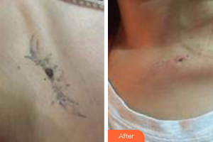 佛山南海區(qū)第二人民醫(yī)院燒傷整形科梁振潮整形價(jià)格表附洗紋身案例展示