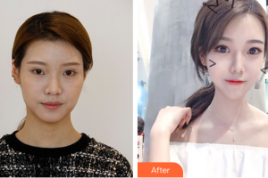 佛山黛顏人醫(yī)療美容門診部胡斌整形價格表附多方面部埋線提升案例展示