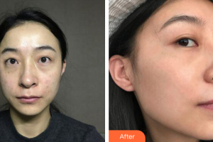 佛山南海區(qū)第二人民醫(yī)院燒傷整形科陸顯斌整形價格表附激光美膚激光祛斑案例展示