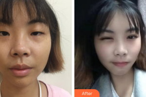 山東省千佛山醫(yī)院整形外科趙悅整形價(jià)格表附眼部綜合案例展示