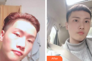 山東省千佛山醫(yī)院整形外科劉瑞鳴整形價格表附雙眼皮案例展示