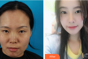 佛山凱潤婷整形美容醫(yī)院卞鵬飛整形價格表附自體脂肪填充案例展示