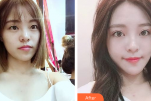 佛山曙光金子醫(yī)學(xué)美容醫(yī)院夏令芳整形價格表附眼部整形案例展示