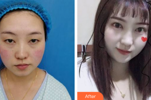 佛山廣美醫(yī)療美容門診部王文整形價格表附眼部手術(shù)案例展示