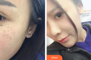 佛山壹加壹瑪麗婭整形美容醫(yī)院凌玲整形價格表附超激光美膚祛斑案例展示