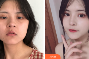 佛山華美整形美容醫(yī)院雷朝勇整形價格表附假體隆鼻案例展示