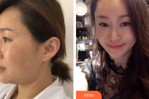 佛山壹加壹瑪麗婭整形美容醫(yī)院袁抒懷整形價格表附面部輪廓案例展示