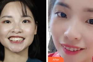 佛山曙光金子醫(yī)學(xué)美容醫(yī)院劉曉勤整形價格表附牙齒矯正案例展示