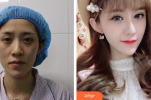 佛山瑞芙臣夢露醫(yī)學(xué)整形美容醫(yī)院林丹整形價格表附脂肪填充案例展示