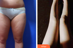 佛山蘇李秀英醫(yī)院激光整形科楊智偉整形價格表附大腿手臂吸脂案例展示