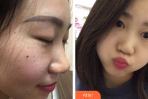 佛山蘇李秀英醫(yī)院激光整形科祝利敏整形價格表附祛雀斑案例展示