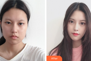 佛山市禪城中心醫(yī)院整形美容科楊偉杰整形價格表附下頜角整形案例展示