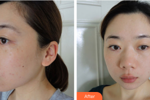 佛山瑞芙臣夢露醫(yī)學(xué)整形美容醫(yī)院DelarivePatricia整形價格表附AOPT祛斑去痘印案例展示