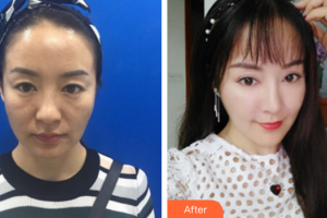 佛山貝爾美醫(yī)學(xué)美容整形醫(yī)院陳海燕整形價格表附埋線提升案例展示