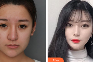 佛山瑞芙臣夢露醫(yī)學(xué)整形美容醫(yī)院李斌整形價格表附鼻部綜合案例展示