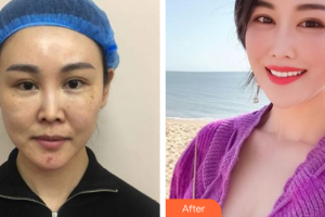 佛山瑞芙臣夢露醫(yī)學(xué)整形美容醫(yī)院SarahKim整形價格表附埋線提升案例展示