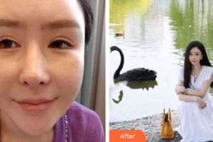 佛山曙光金子醫(yī)學(xué)美容醫(yī)院李淑薇整形價格表附眼修復(fù)案例展示