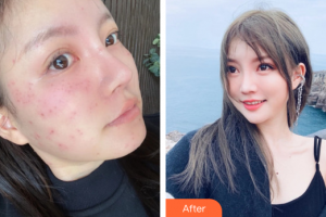 佛山曙光金子醫(yī)學(xué)美容醫(yī)院張芝才整形價格表附激光祛斑案例展示