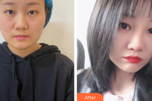 佛山美嘉美醫(yī)療美容門診部樸善在整形價格表附埋線雙眼皮案例展示