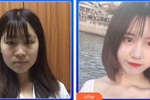 佛山華美整形美容醫(yī)院夏相員整形價格表附眼部綜合案例展示