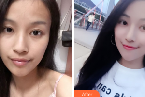 佛山貝爾美醫(yī)學美容整形醫(yī)院戴耕武整形價格表附鼻部手術(shù)案例展示