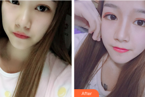 佛山貝爾美醫(yī)學美容整形醫(yī)院李晟源整形價格表附鼻部整形案例展示