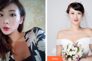 佛山廣美醫(yī)療美容門診部羅雄鵬整形價格表附鼻部手術(shù)案例展示